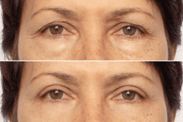 Resurfacing com Laser de CO2 Fracionado