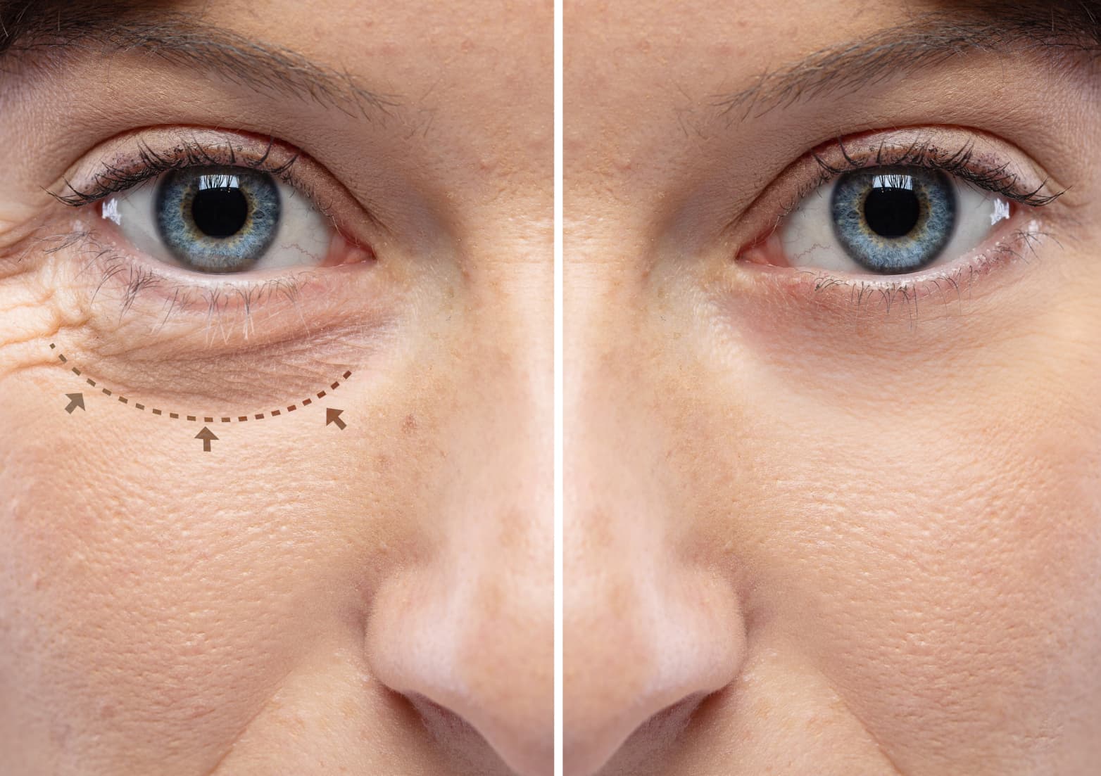 Blefaroplastia