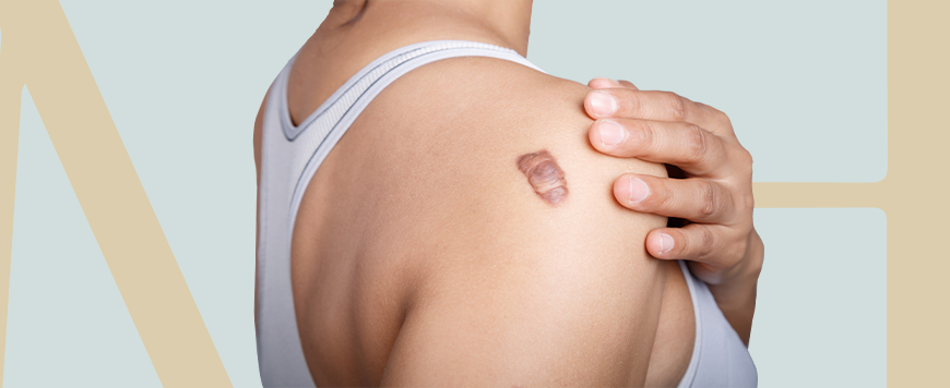 Imagem Cirurgia de tumor/câncer de pele